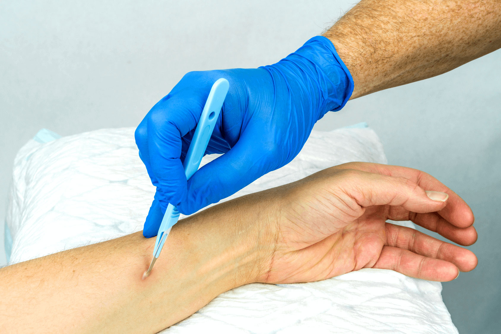 Abscess: Types, Symptoms, Causes, and ER Treatment