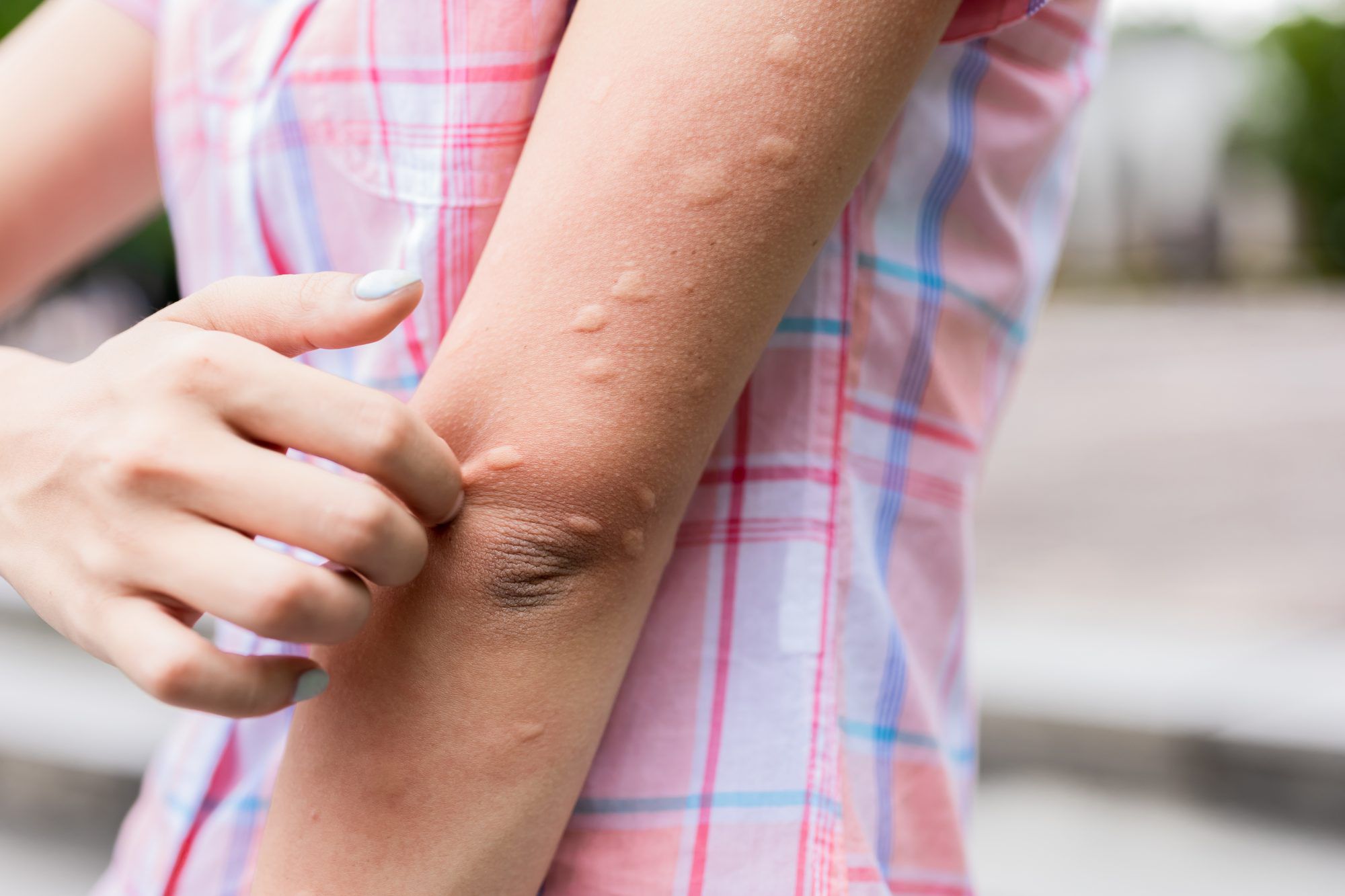 Common Causes of Hives That Will Surprise You - ER of Texas