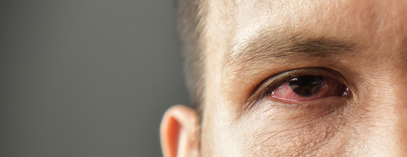 Symptoms of pink eye can vary but typically include redness or swelling of the white of the eye.