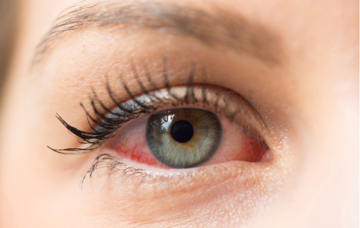Visit the nearest emergency room for eye treatment in the Dallas-Fort Worth area, TX.