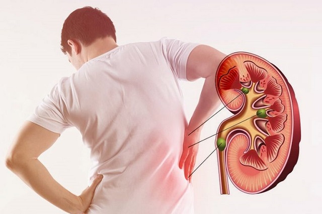 Kidney Stones: Causes, Symptoms, Diagnosis, and ER Treatment