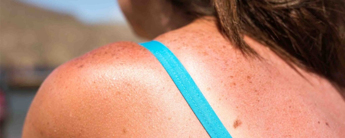 A severe sunburn can cause significant damage to the skin and lead to serious health problems. Learn about the warning signs of a severe sunburn and when to seek medical treatment to prevent complications such as dehydration, infections, and even skin cancer.
